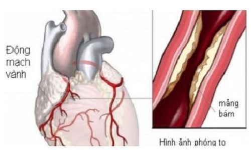 
Xơ vữa động mạch vành nuôi cơ tim có thể dẫn đến thiếu máu cơ tim
