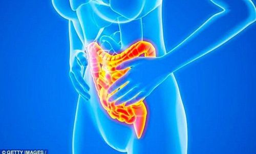 Bệnh Crohn là một tình trạng liên tục (mãn tính) khiến đường tiêu hóa (GI) bị viêm