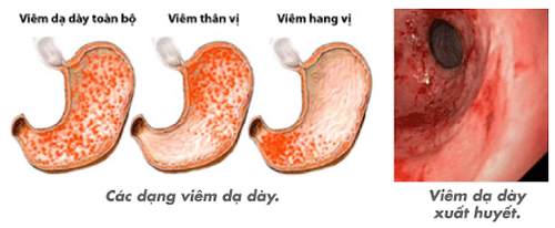 Is atrophic gastritis grade 3 dangerous?