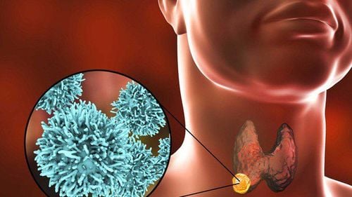 What to eat after thyroid goiter surgery?