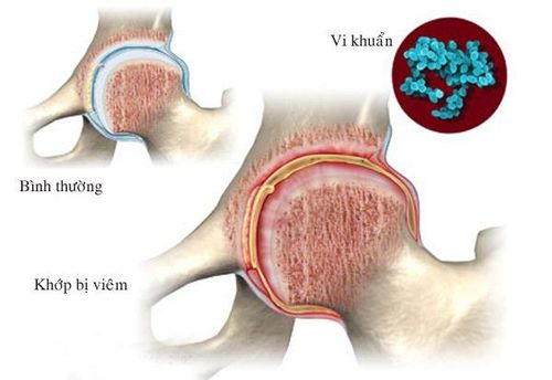 
Bệnh lý viêm khớp nhiễm khuẩn không thể xem nhẹ
