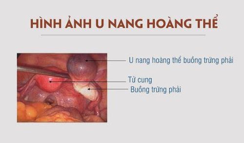 
Nang hoàng thể là u buồng trứng cơ năng, là tình trạng thường gặp và đa số là vô hại
