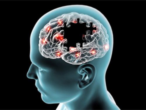 
Bệnh Alzheimer là nguyên nhân phổ biến nhất gây ra chứng sa sút trí tuệ ở người già
