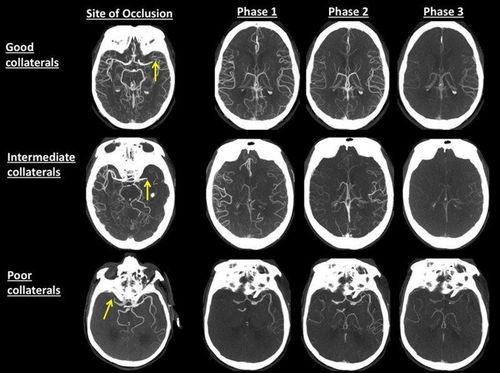 When is a CT angiogram of the brain needed?