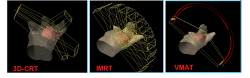 
Hình 3. Thiết kế trường chiếu trong 3 kế hoạch: a) 3D-CRT, b) IMRT, c) VMAT
