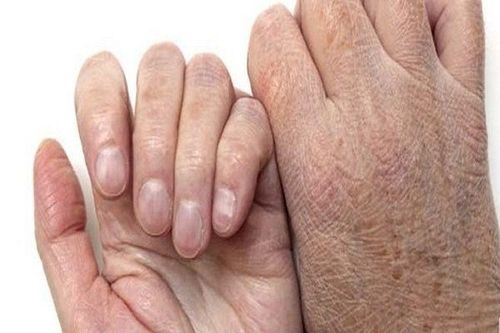 Nguyên nhân và cách xử lý mu bàn tay nóng rát kèm nứt nẻ ngón tay khi lạnh?