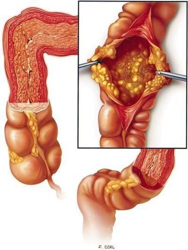 Diarrhea with indigestion, nausea is a sign of intestinal tuberculosis?