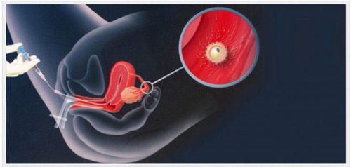 Tỉ lệ thành công của thụ tinh nhân tạo khi bị viêm âm đạo kèm nội mạc tử cung mỏng?