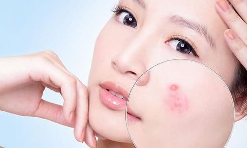 What is acne and why is it difficult to treat?