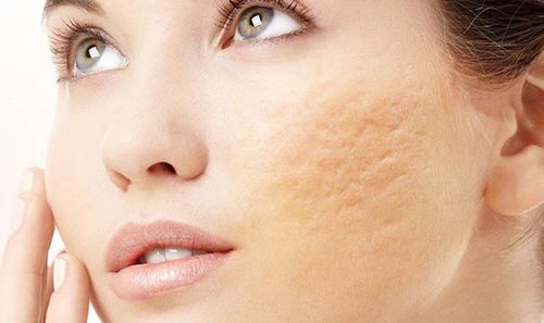 Methods to treat pitted scars