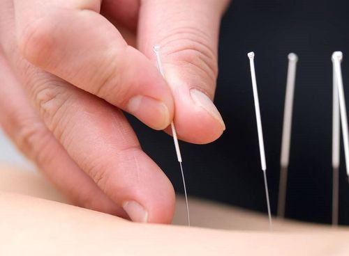 Acupuncture: How it works, its benefits and pain relief results