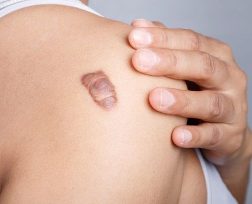 What to do with keloid scars?