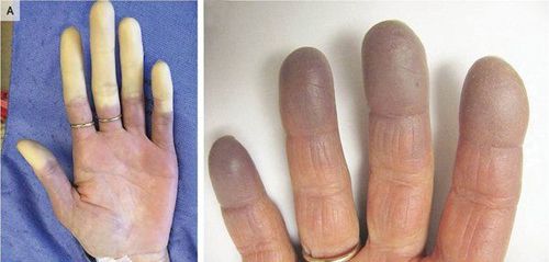 
Hình ảnh tay người mắc bệnh Raynaud
