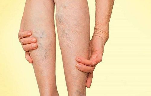 Huyết khối tĩnh mạch sâu là một biến chứng thường gặp đe dọa tính mạng ở bệnh nhân ung thư