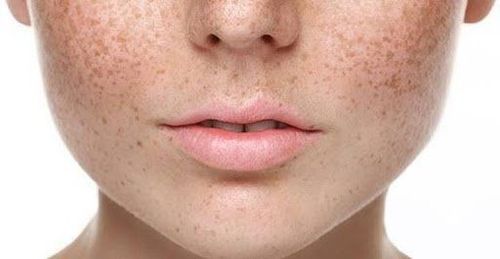 Distinguish melasma and freckles