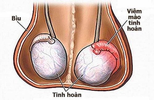 Đau tinh hoàn cảm giác như tụt ruột xuống phải làm gì?