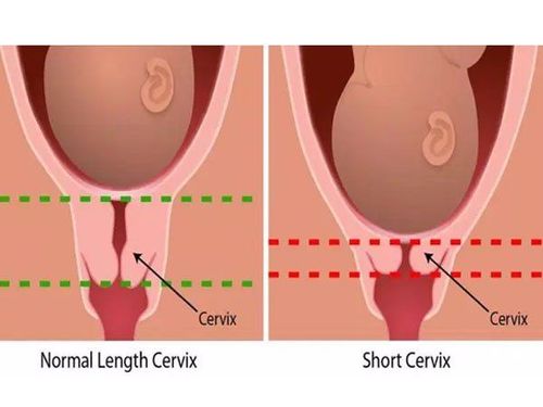 Cổ tử cung ngắn khi mang thai có sao không?