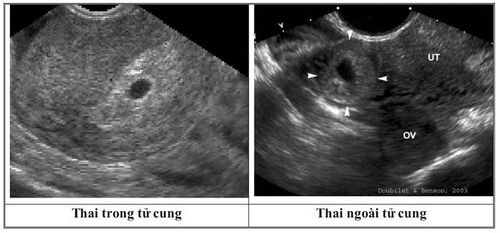 Dấu hiệu thai ngoài tử cung trên siêu âm?