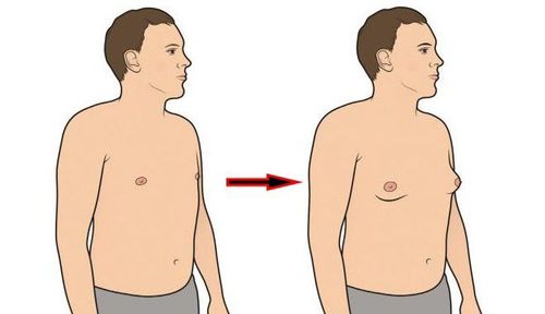 
Bệnh vú to ở nam giới, có tên tiếng anh là “Gynecomastia”, chỉ tình trạng tuyến vú ở người đàn ông có kích thước mô vú lớn hơn bình thường (khoảng 5 cm)
