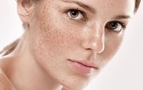 How to get rid of freckles?