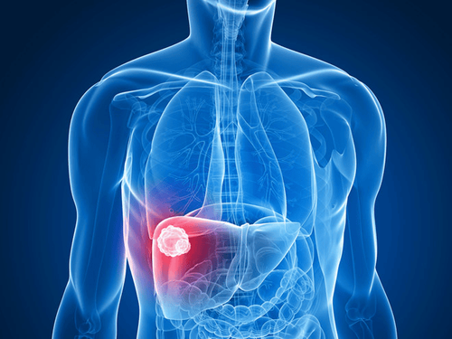 Is 4mm benign liver calcification dangerous?