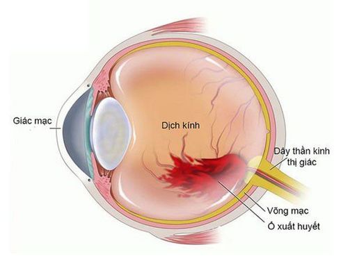 What is vitreous hemorrhage?