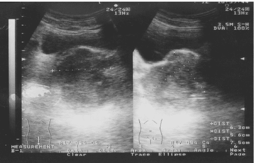 
Hình ảnh cộng hưởng từ Sarcoma cơ vân của tuyến tiền liệt
