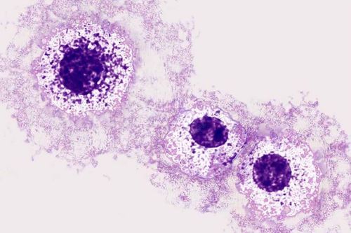 Hội chứng bệnh tế bào Mast (Mastocytosis) có nguy hiểm?