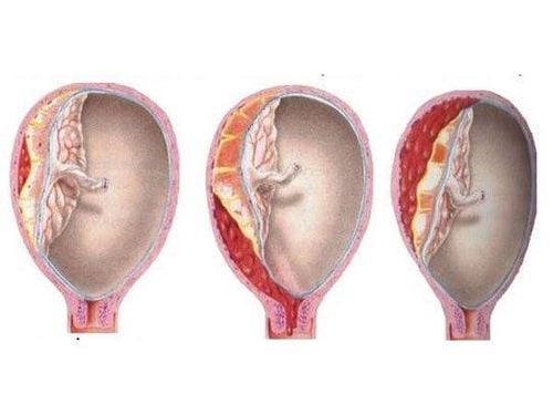 12 weeks pregnant, 10% dissection, is it okay?