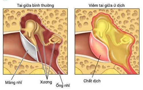 
Viêm tai tiết dịch thường gặp nhiều ở trẻ em
