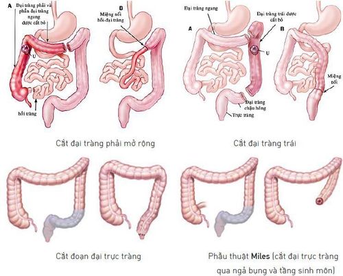 
Mục tiêu của phẫu thuật là loại bỏ những đoạn đại tràng bị bệnh.
