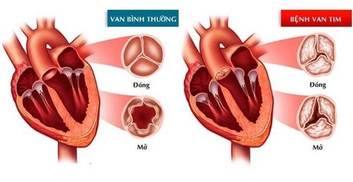 Anesthesia in valvular heart disease