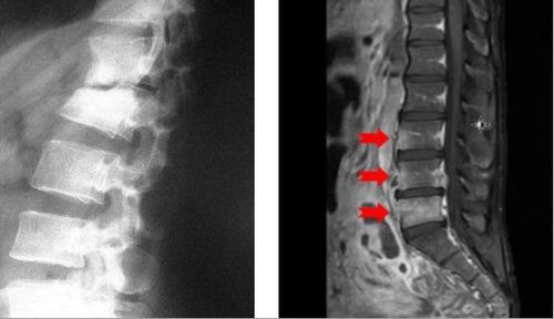 
Xẹp nhẹ thân đốt sống do lao
