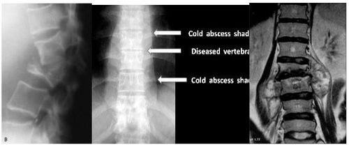 
Xẹp thân đốt sống và khối Abscess lạnh cột sống do lao
