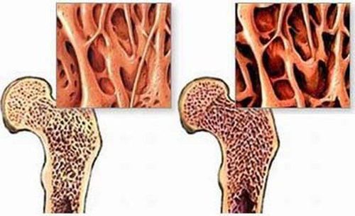 Mô viêm ở xương có thể điều trị hết được không?