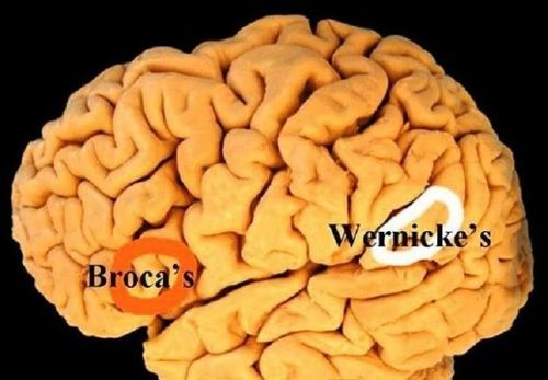 What is Wernicke Encephalopathy?