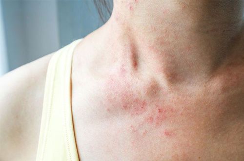 Hội chứng tự viêm Autoinflammatory