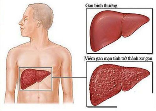 Vì sao xơ gan dễ gây vỡ tĩnh mạch thực quản?