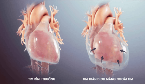 Is pericardial effusion after dengue treatment dangerous?