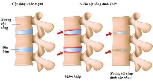 Dính đốt sống có cách nào tách ra không?