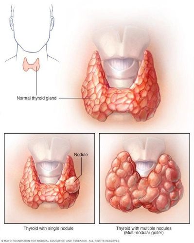 Phình giáp đa hạt làm tuyến giáp to ra có cần phẫu thuật không?