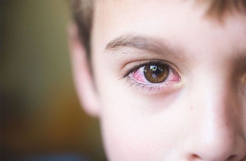 Mắt trẻ 2 tuổi nhiều mạch máu, tối hơn mắt còn lại là dấu hiệu bệnh gì?