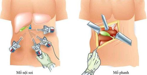 Cắt túi mật có ảnh hưởng đến sức khỏe và tuổi thọ không?