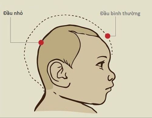 Tật đầu nhỏ ở thai nhi - Những điều mẹ bầu cần biết