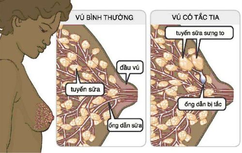 Phụ nữ đang cho con bú bị tắc sữa kèm sốt phải làm thế nào?