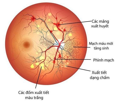 Does diabetic retinopathy cause permanent vision loss?