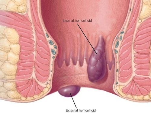 Điều trị trĩ nặng như thế nào?