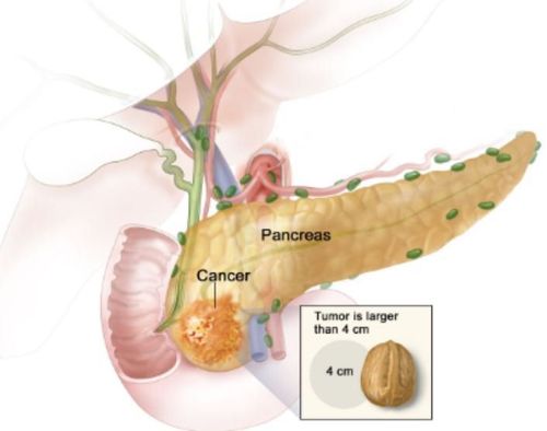 
Ung thư tụy rất khó chẩn đoán
