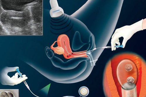 Sau chuyển phôi 6 tuần bị ra dịch nâu kèm đau lưng dưới có sao không?