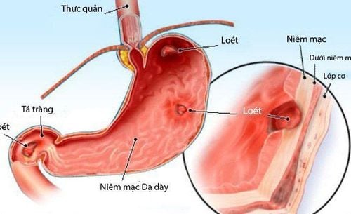 Loét nông hành tá tràng có điều trị được không?